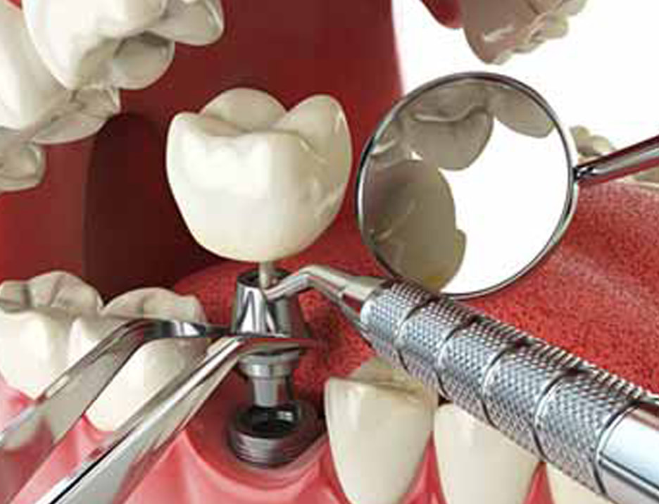 dental implants st catharines ontario